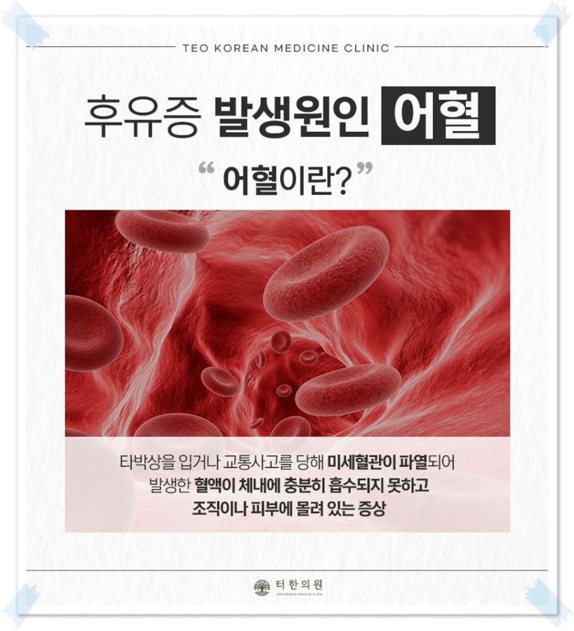 교통사고 뒤 생기는 어혈을 설명한 안내문