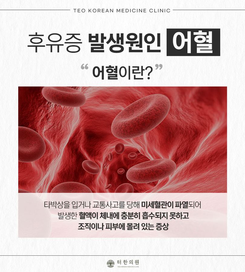 어혈을 설명한 적혈구 이미지