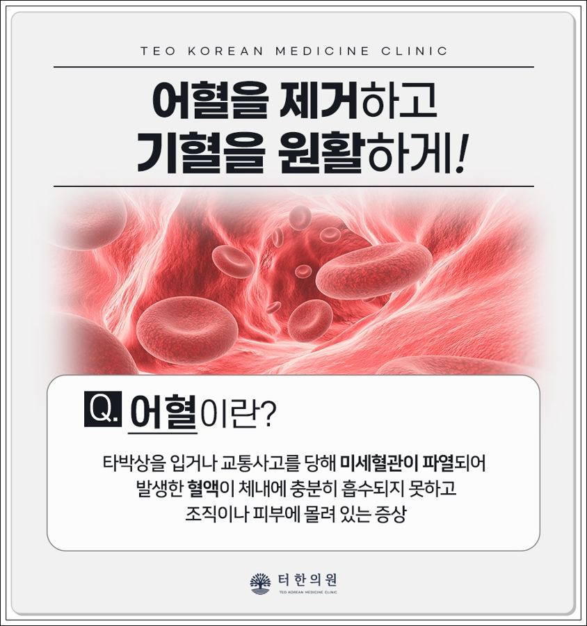 어혈의 의미와 생활 관리 방법을 설명한 안내문