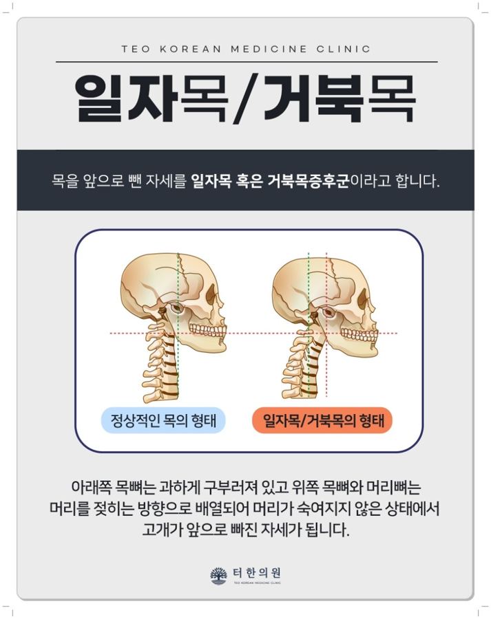 일자목과 거북목을 비교한 해부 그림