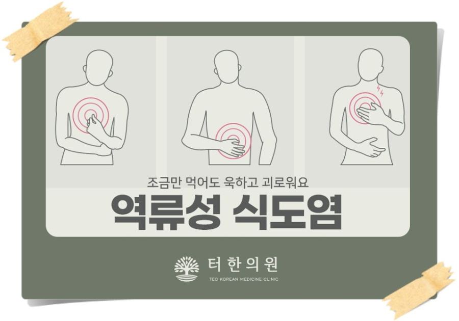 역류성 식도염 증상을 표현한 일러스트
