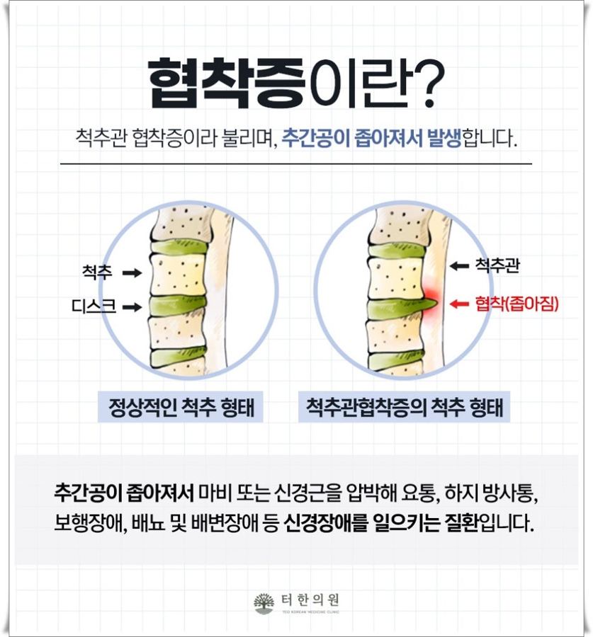 정상 척추와 척추관협착증 척추 형태를 비교 설명한 그림