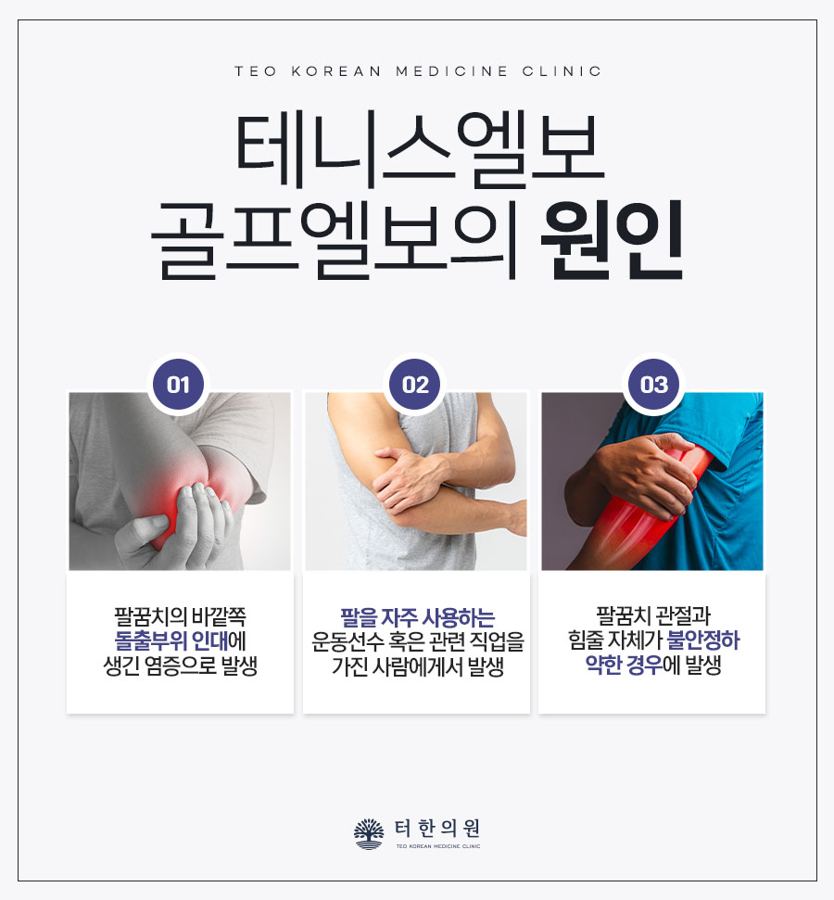 테니스엘보와 골프엘보의 세 가지 원인을 설명한 이미지