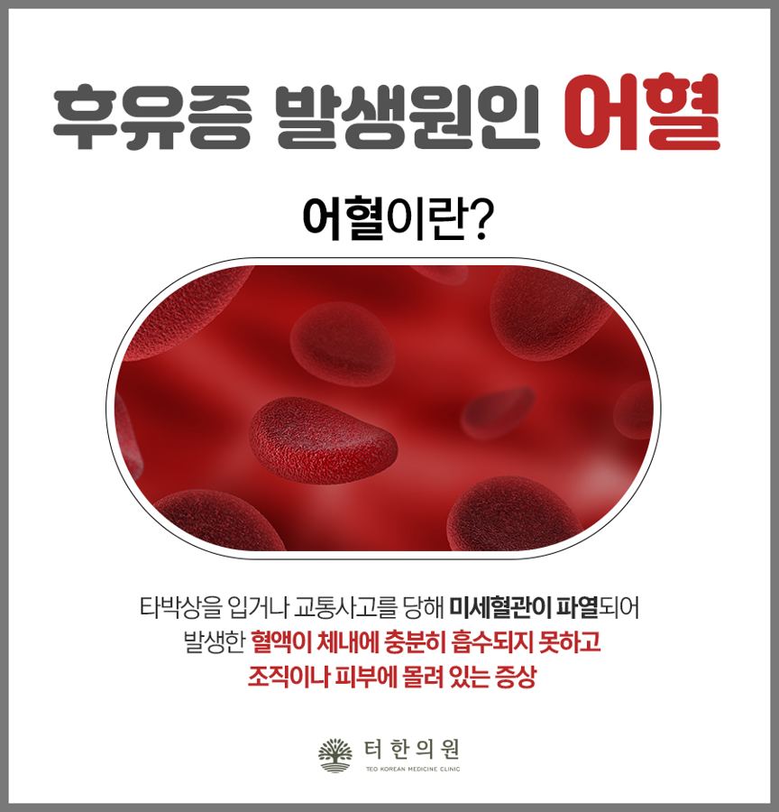 적혈구 그림과 교통사고 후 어혈 발생 원인을 설명한 이미지