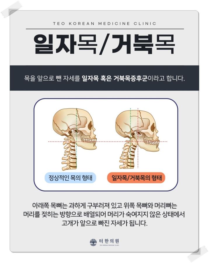 정상적인 목과 일자목·거북목의 형태를 비교 설명한 해부 그림