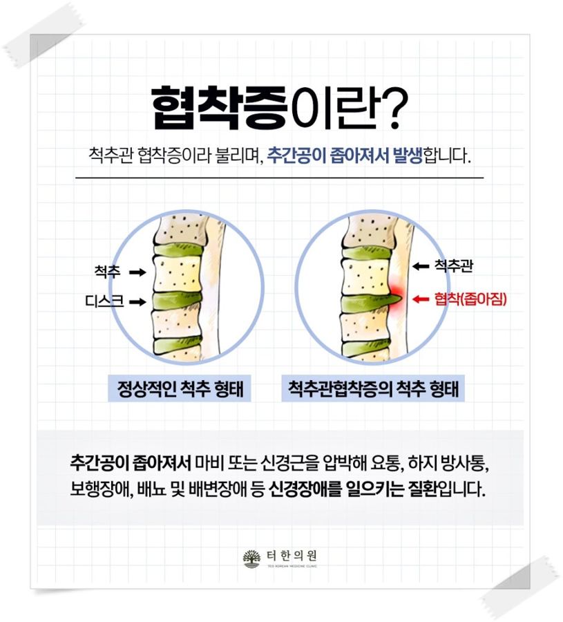 정상 척추와 척추관협착증 척추의 차이를 설명한 그림