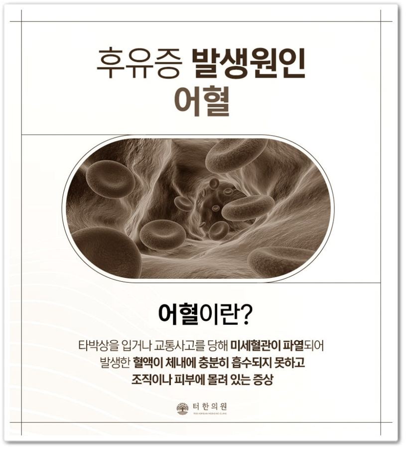 후유증 발생원인 어혈을 설명하는 카드뉴스