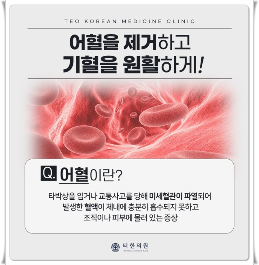 혈관 그림과 함께 어혈의 뜻을 설명한 안내 그래픽